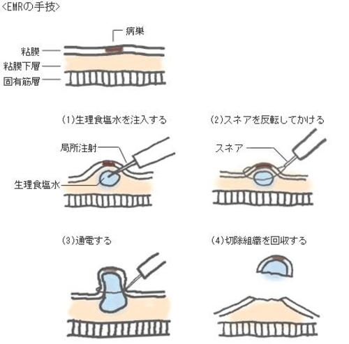 H25.7 最近の早期胃がんの内視鏡治療(ESD)と適応について
