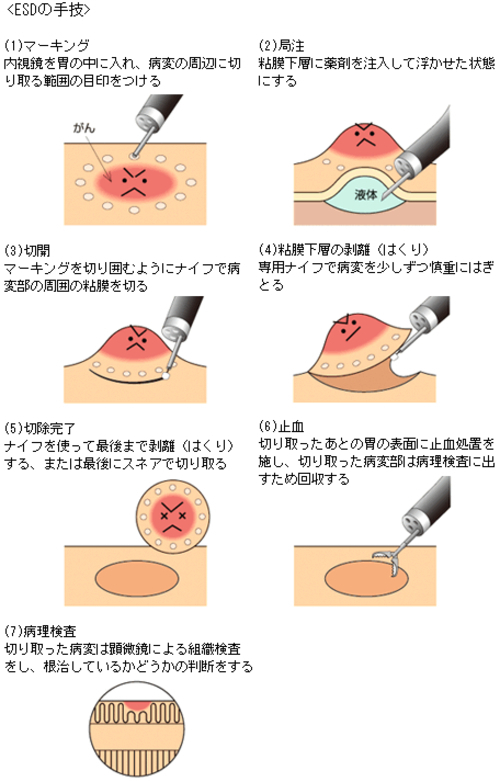 H25.7 最近の早期胃がんの内視鏡治療(ESD)と適応について